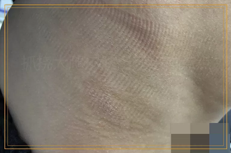 抓挠大腿皮肤出现小白点点怎么办