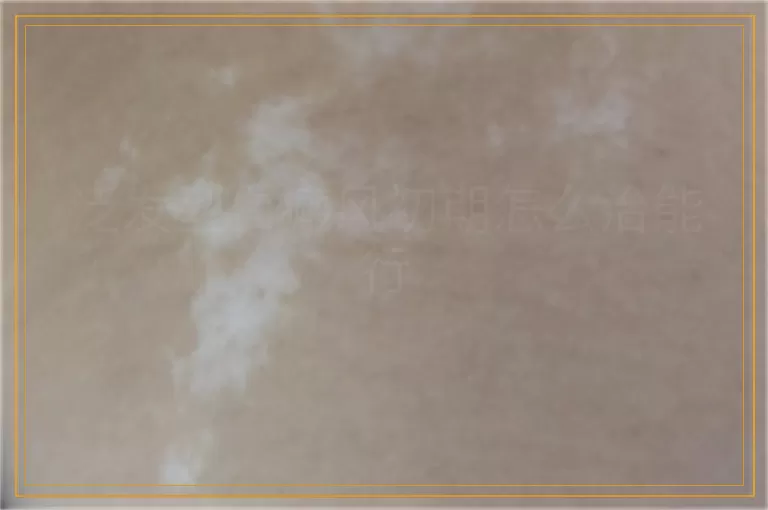 泛发型白癜风初期怎么治能行