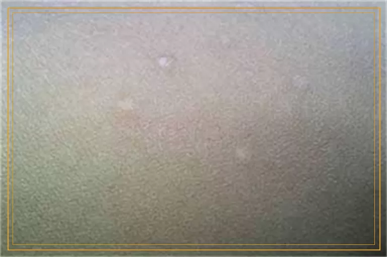 什么样的白癜风能用黑色素种植治疗