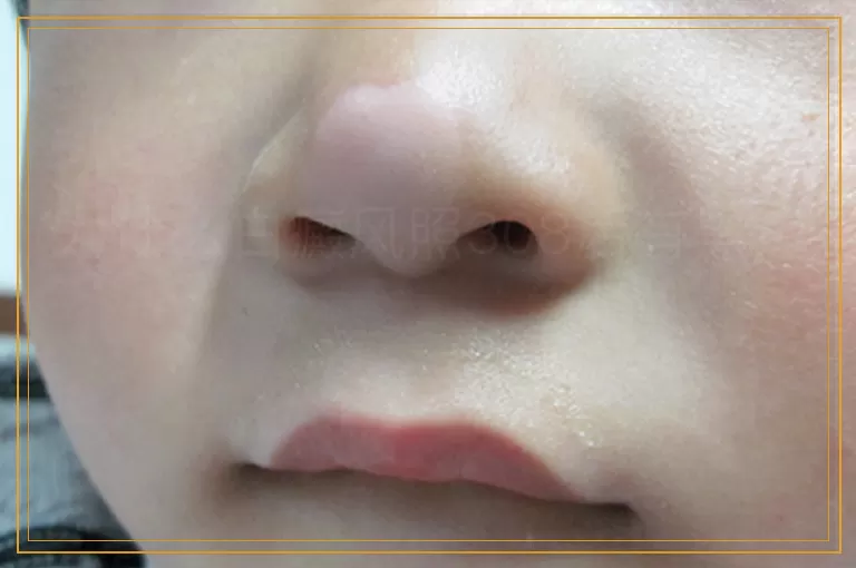 为什么白癜风照308后有黑边