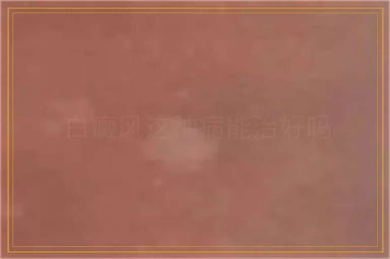 白癜风这种病能治好吗