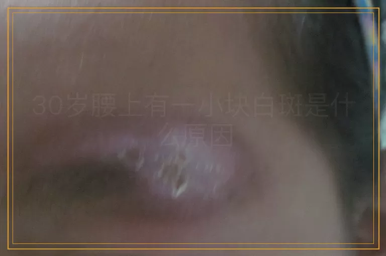 30岁腰上有一小块白斑是什么原因