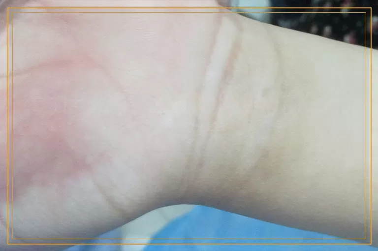 为什么手上白癜风照光没什么效果