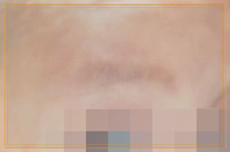 白癜风手术后拆纱布掉皮不碍事吧