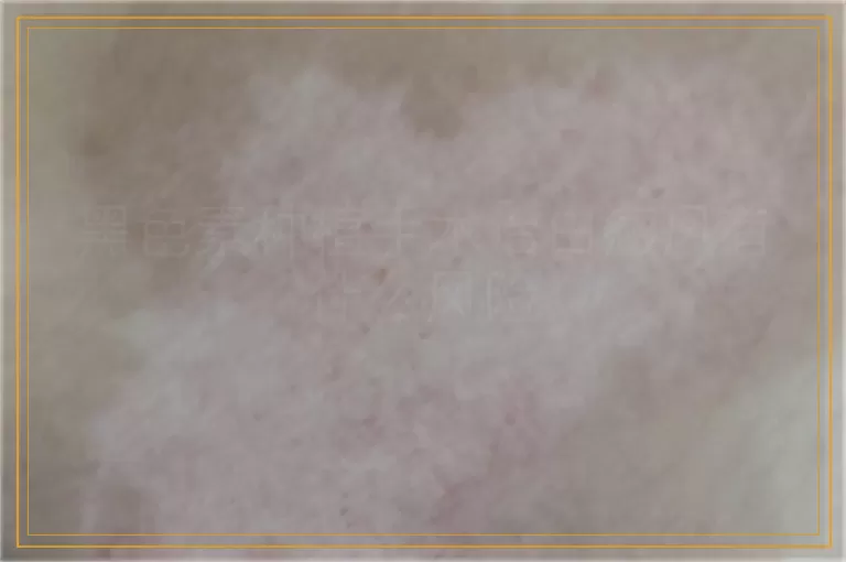 黑色素种植手术治白癜风有什么风险