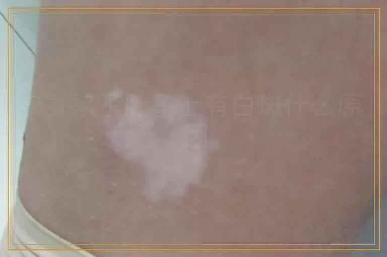 2岁孩子肚子上有白斑什么原因