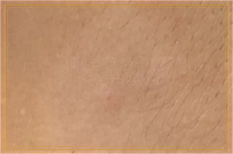 白癜风吃灵芝孢子粉对治疗管用吗