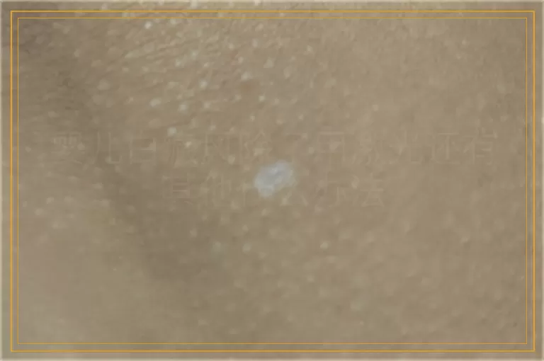 婴儿白癜风除了用激光还有其他什么办法