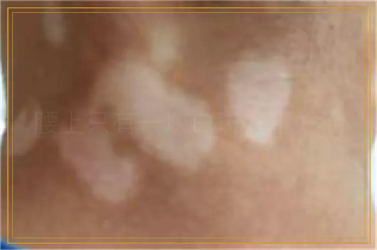 腰上只有一块白斑好不好治