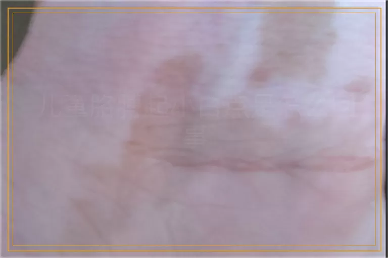 儿童胳膊起小白点是怎么回事