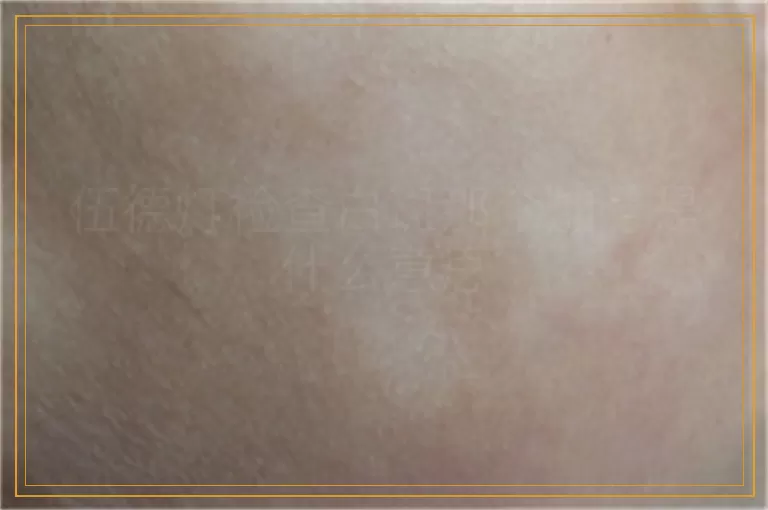 伍德灯检查白斑那个加号是什么意思