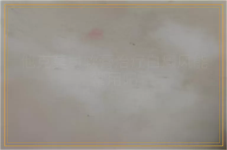 他克莫司软膏治疗白癜风能常用吗