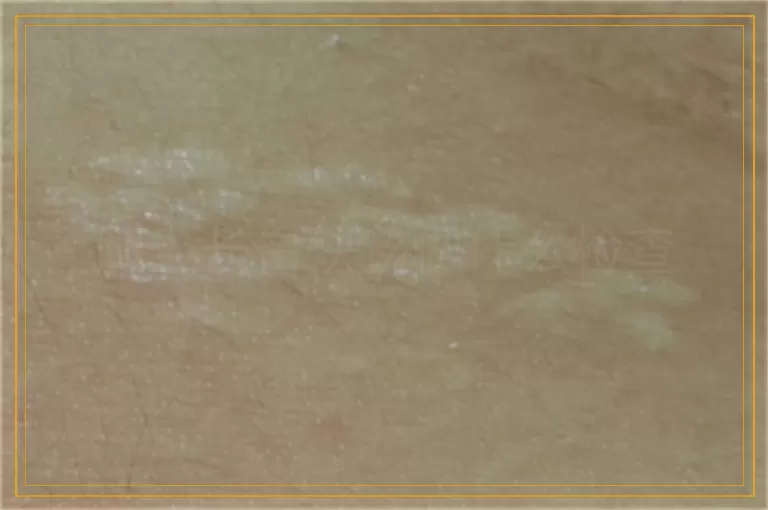 腿上长白块该做什么检查