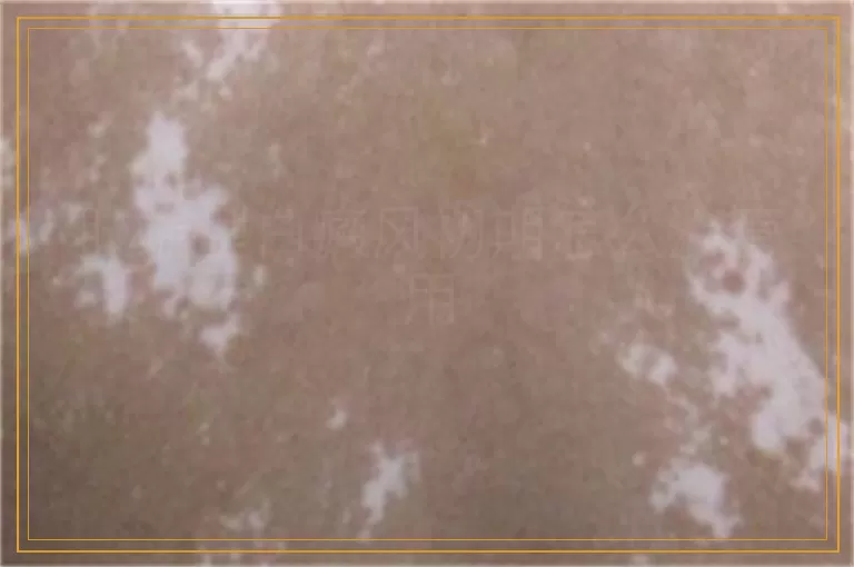 肢端型白癜风初期怎么治管用