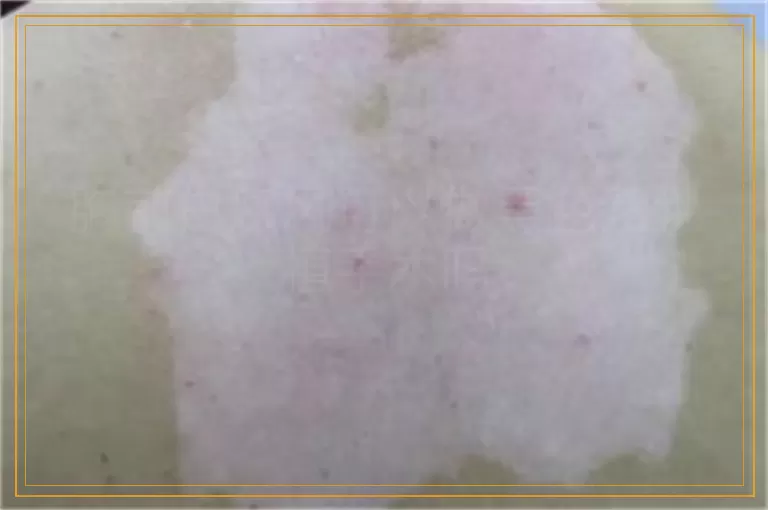 胸前白癜风可以做黑色素种植手术吗