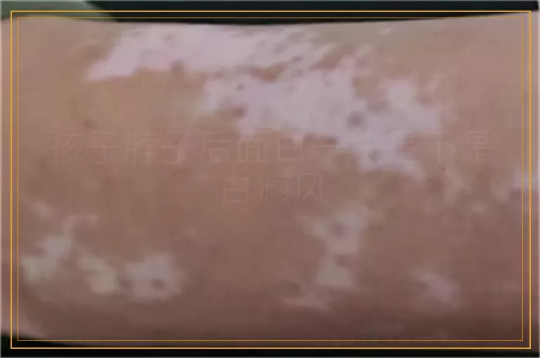 孩子脖子后面白一块是不是白癜风
