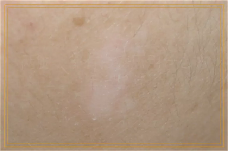 两腿上都有白癜风用什么方法治疗好