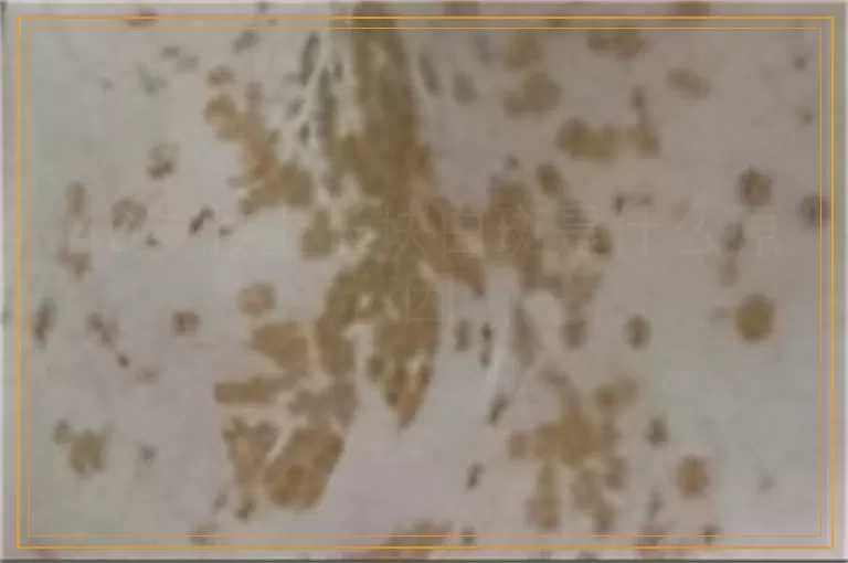 40岁腰上长块白斑是什么原因