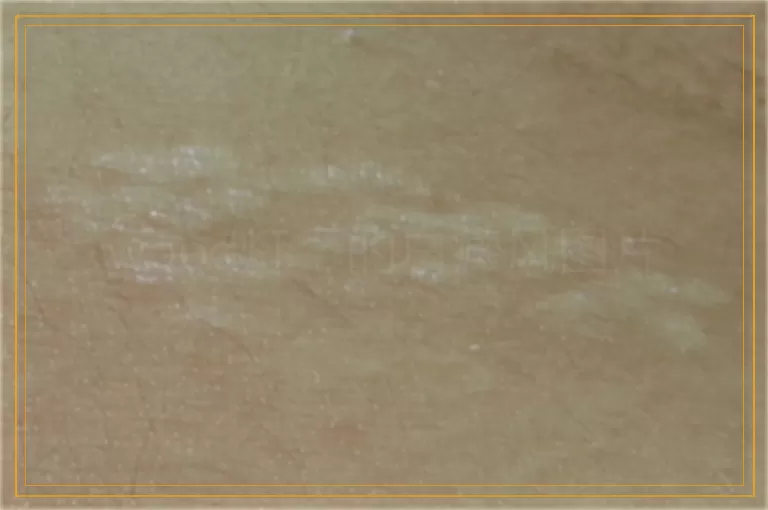 wood灯下的白癜风图片