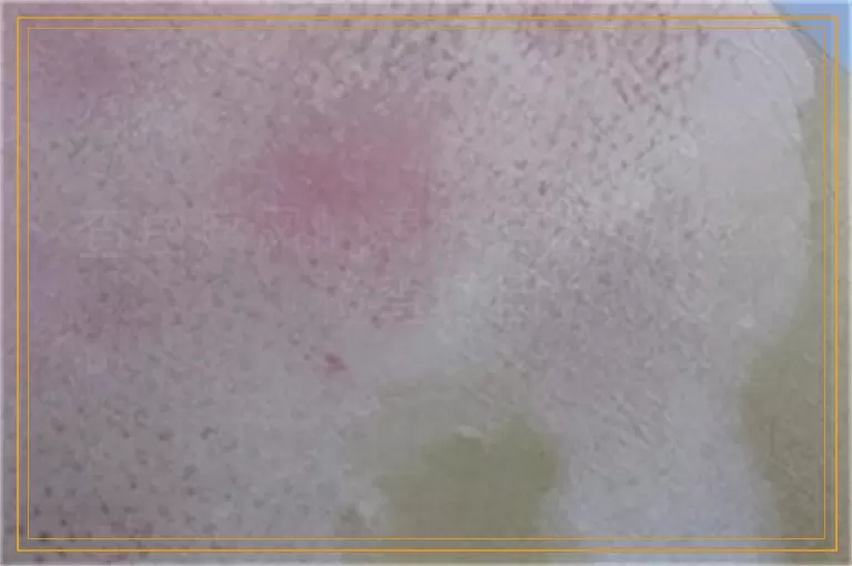 查白癜风的患病原因做什么检查项目