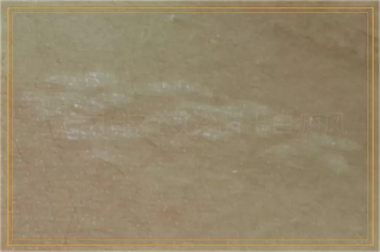 怎样才能有效诊断出白癜风