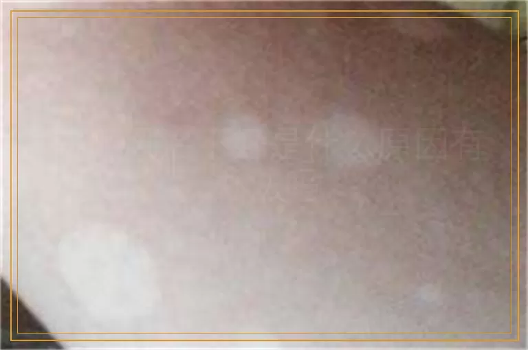 白癜风治不好是什么原因有办法吗