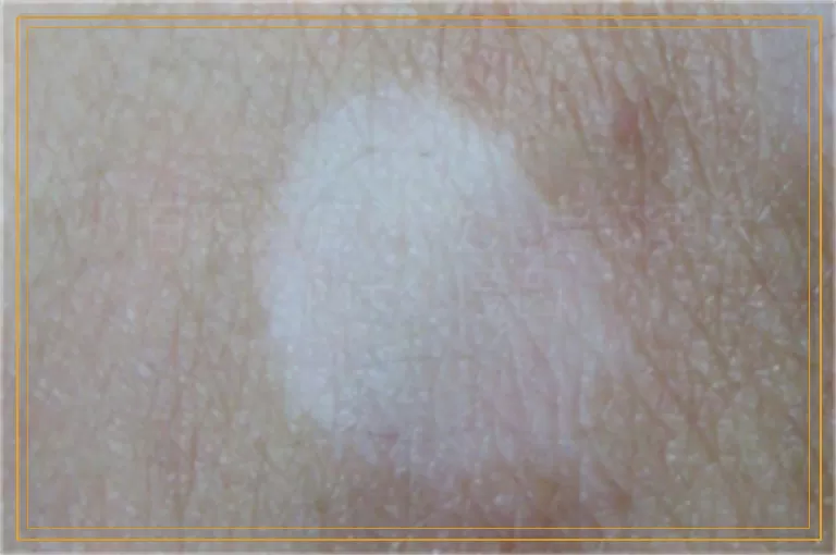 小面积白癜风激光后变更大了什么原因