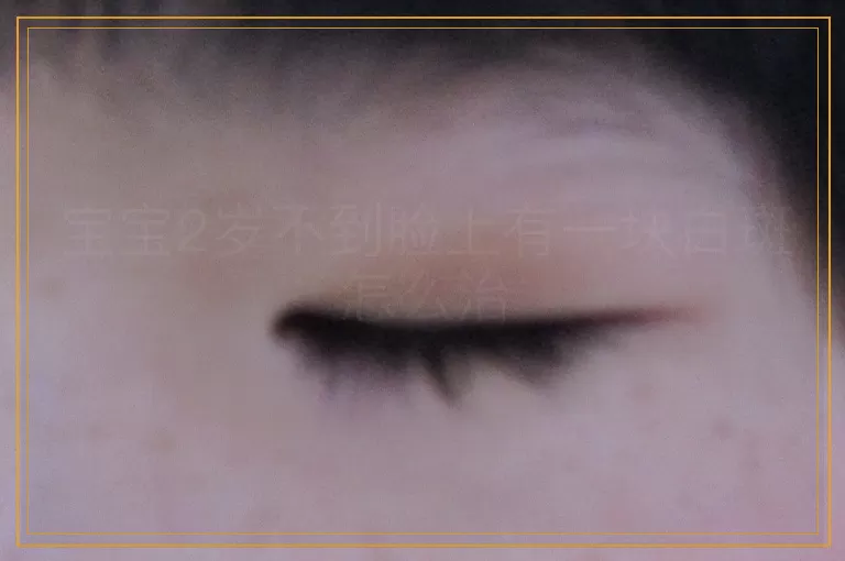 宝宝2岁不到脸上有一块白斑怎么治