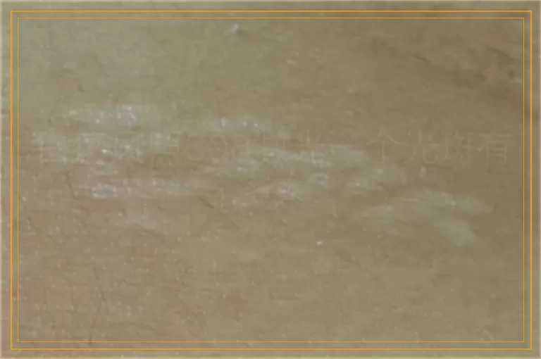 白癜风照308激光一个光斑有多大