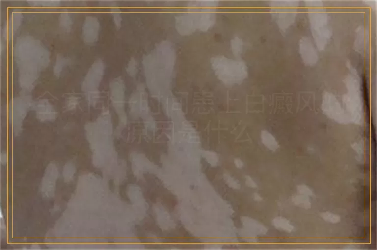 全家同一时间患上白癜风的原因是什么