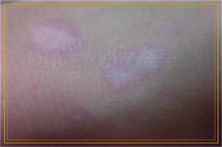 手臂和后背出现白点用他克莫司能治好吗