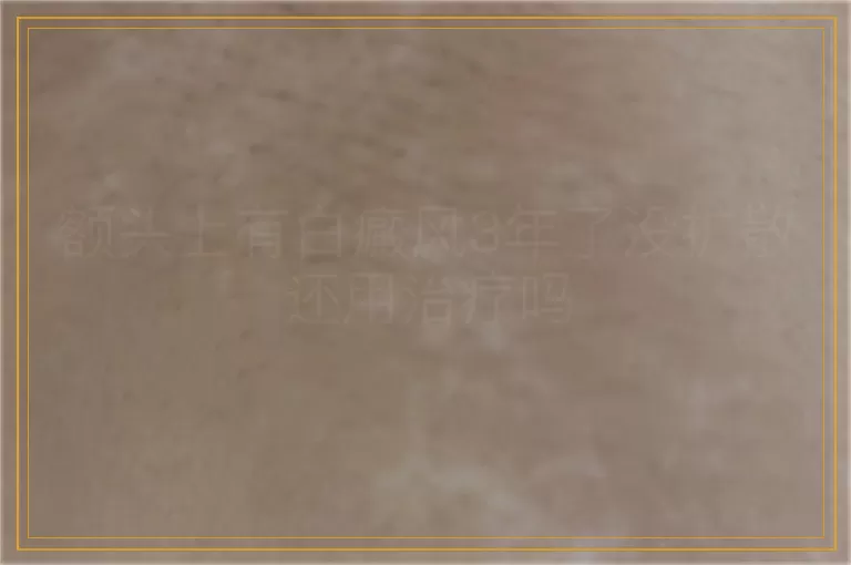 额头上有白癜风3年了没扩散还用治疗吗