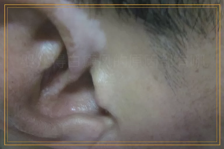 婴儿得白癜风的原因都有哪些？