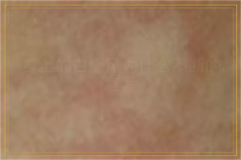 身上的白癜风为什么不断的复发