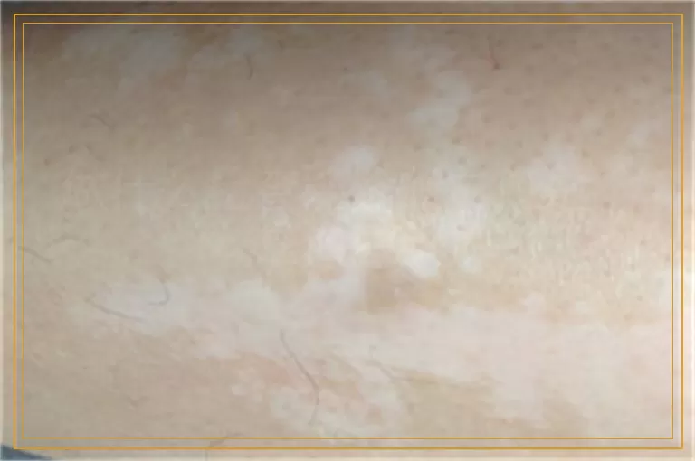 做什么检查能诊断白斑是不是白癜风