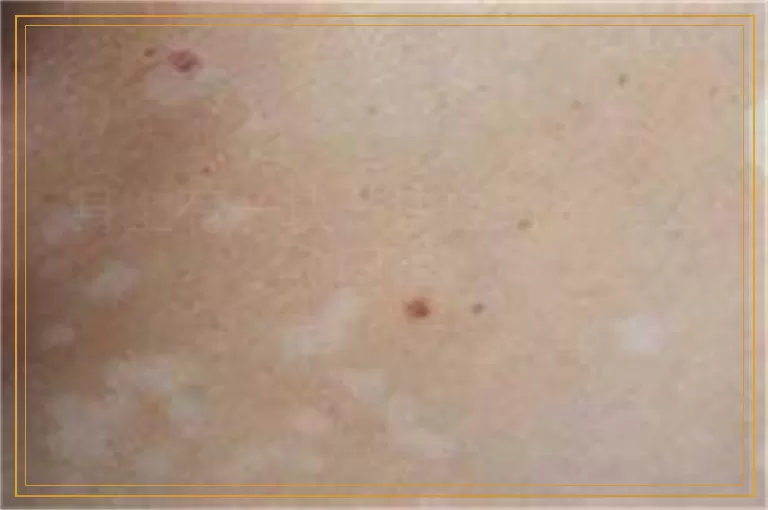 身上有一块一块白斑是怎么回事