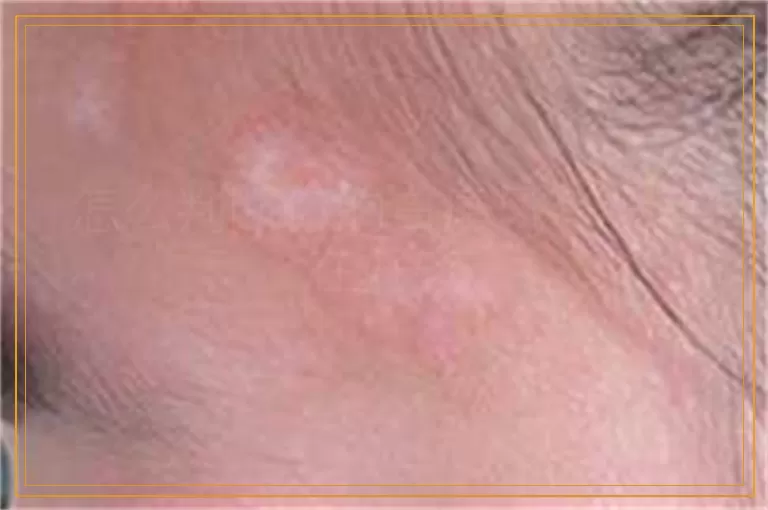 怎么判断你的白癜风有没有在好转