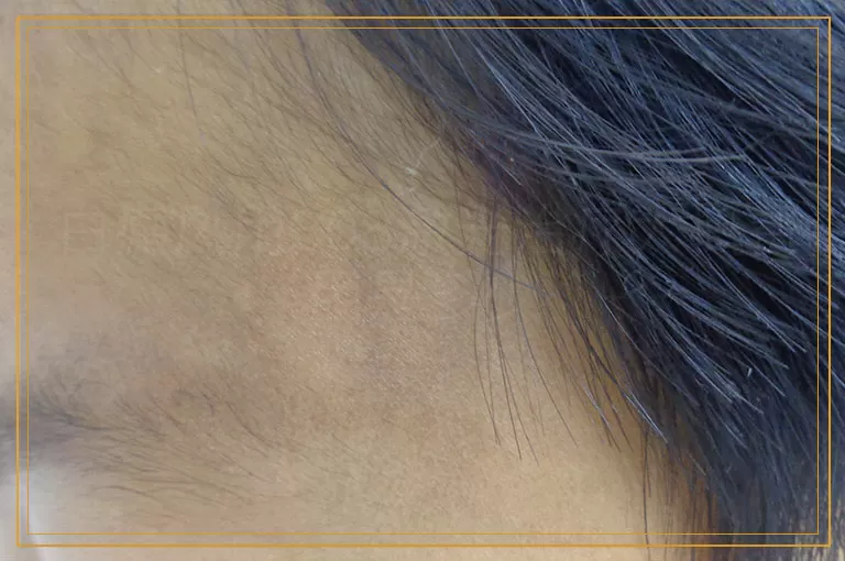 白癜风用308激光治疗大概费用是多少