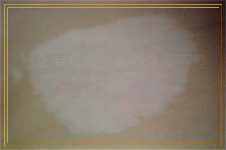 脸上有几处淡淡的白是不是白癜风