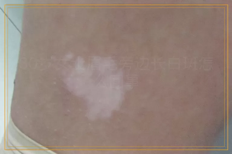30岁女士眉毛旁边长白斑怎么回事