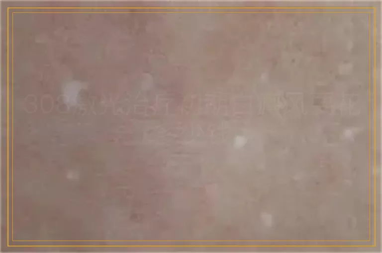 308激光治疗初期白癜风要花多少钱