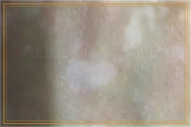 手上长白癜风是什么原因引起的