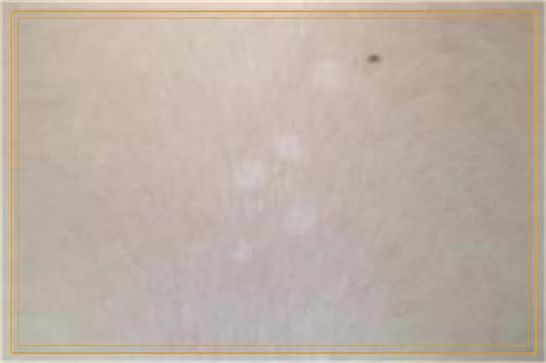 脸上一小块白癜风大约花多少钱能治好