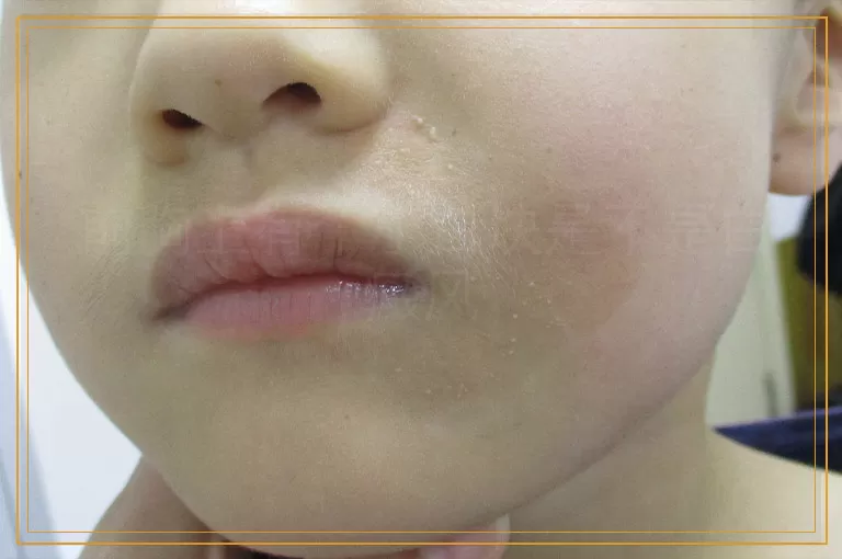 前胸上有个小白块是不是白癜风