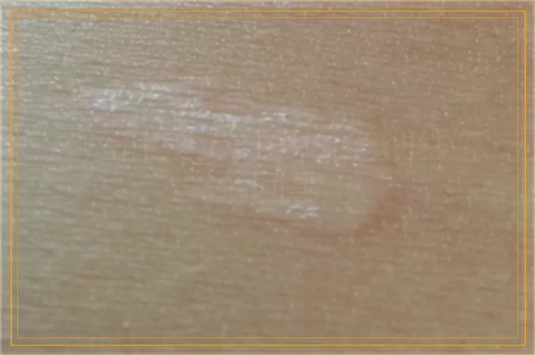 产后肚皮上好多白色细线怎么回事