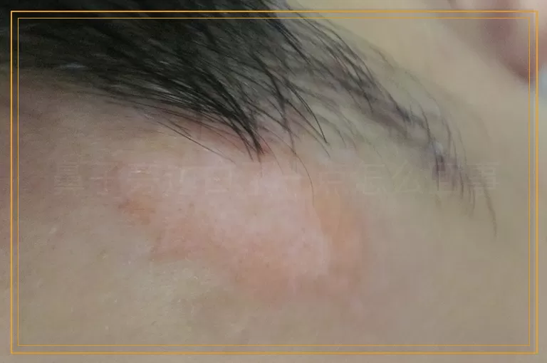 鼻子旁边白了一点怎么回事