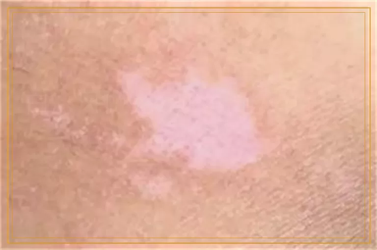 白癜风做完308激光好转的表现是什么