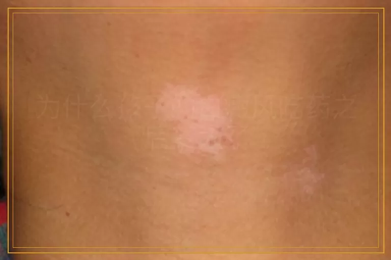 为什么孩子的白癜风吃药之后变大了