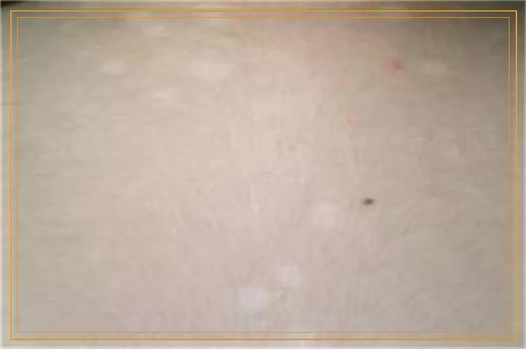 白癜风照了308有点痒什么原因