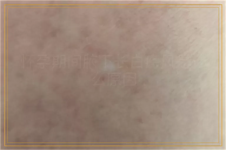 怀孕期间腋下长白癜风是什么原因